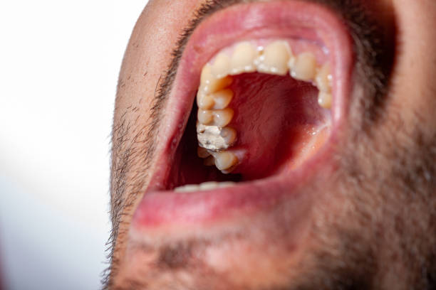 istock temporary filling of a tooth caries patient 1162182967