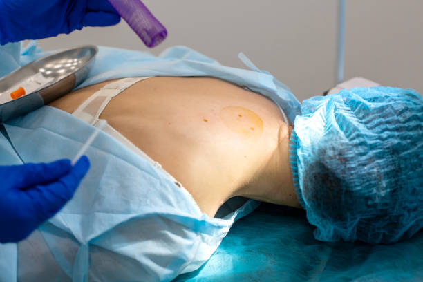 istock The surgeon does surgery to remove the mole on the patient's back. The process of burning moles in a private clinic to remove moles 1162185594