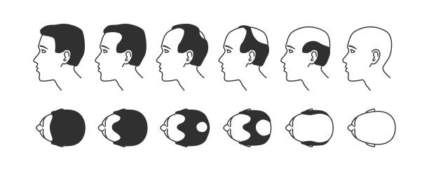 ilustrações, clipart, desenhos animados e ícones de estágios de calvície - alopecia homem