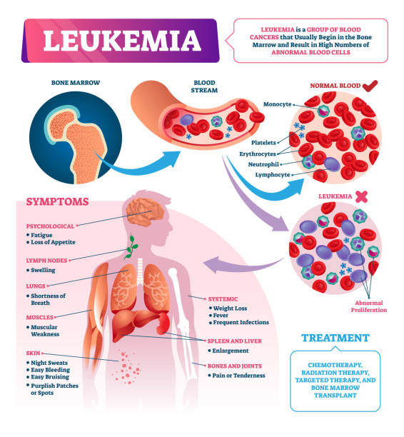 Leukemia vector illustration. Labeled educational blood cancer infographic. Leukemia vector illustration. Labeled educational blood cancer infographic. Bone marrow and abnormal cells disease. Medical diagnosis symptoms and ill treatment list. Compared normal and sick closeup. anemia diagram stock illustrations
