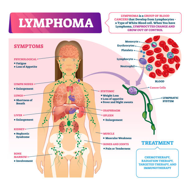 Lymphoma vector illustration. Labeled educational blood cancer type scheme. Lymphoma diagnosis vector illustration. Labeled educational blood cancer type scheme. Disease treatment and symptoms list. Patient with sick blood cell closeup and isolated lymphatic system diagram. neutrophil diagram stock illustrations