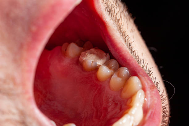 istock temporary filling of a tooth caries patient 1162318729