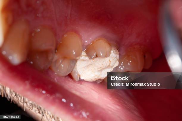 Temporary Filling Of A Tooth Caries Patient Stock Photo - Download Image  Now - Illness, Bubble Gum, Teeth - iStock