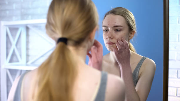 istock Young lady with face acne touching face in front of mirror, puberty skin problem 1162337054