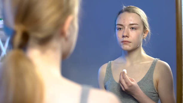 Young lady with face puberty pimples looking in mirror and holding cotton pad
