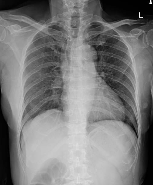 istock Multiple  fracture ribs x-ray chest. 1162361824