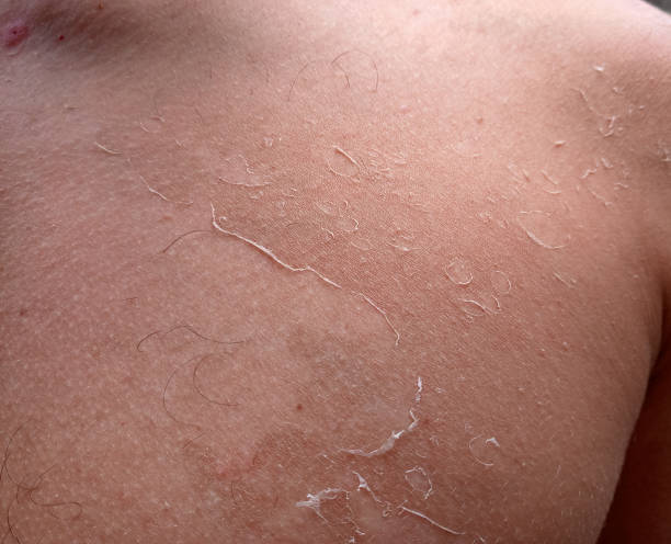 istock effects of sunburn on the skin. Climb skin. 1162425888