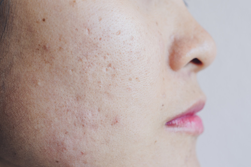 El primer plano de la cara de mujer asiática tiene problemas con la piel en la cara. photo