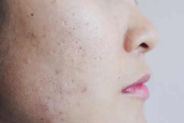 Problems with acne and scar on the female skin.
