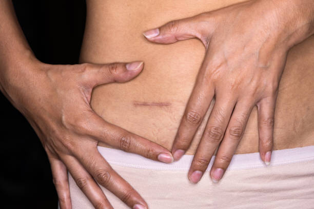 woman showing on your stomach with a appendicitis scar, appendicitis scar on the woman stomach. - abdomen abdominal muscle muscular build beautiful imagens e fotografias de stock