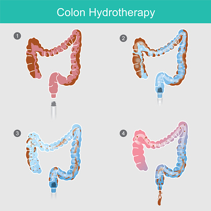 Colon Hydrotherapy. The secreted of waste that accumulates in the colon wall for a long time,
Can use the removal method by inserting water solution hose to flush colon.