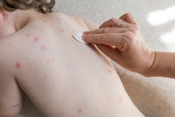 istock Mother cooling varicella zoster rash 1162705475