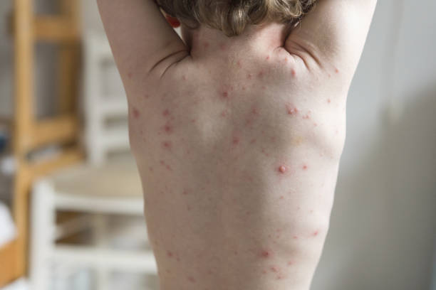 istock Young boy infected with varicella zoster virus 1162705481