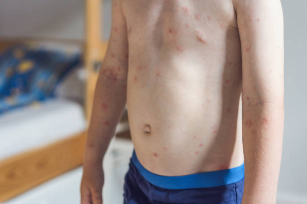 istock Boy with varicella zoster virus 1162705543