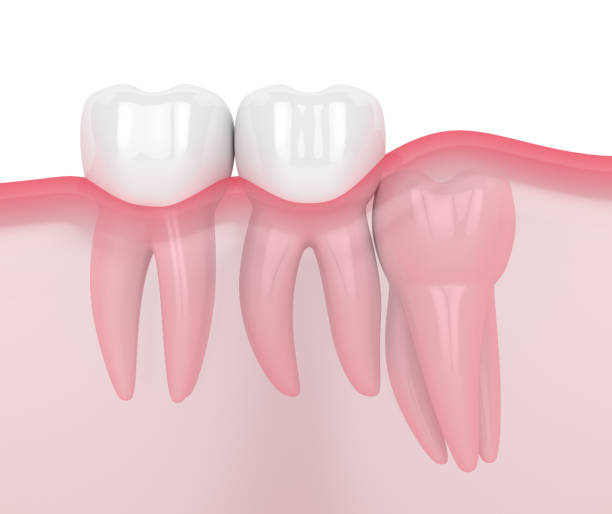 istock 3d render of jaw with wisdom vertical impaction 1162728136
