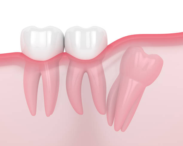 istock 3d render of jaw with wisdom distal impaction 1162728143