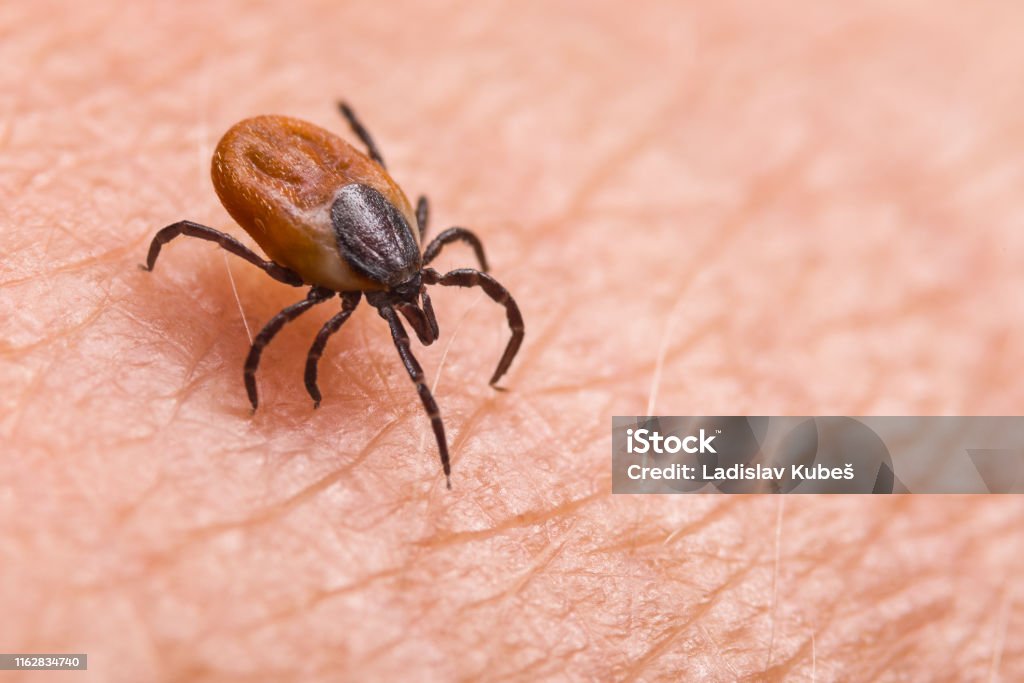 Infected female deer tick on hairy human skin. Ixodes ricinus. Dangerous mite detail. Acarus. Infectious borreliosis Parasitic biting insect on background of epidermis detail. Disgusting carrier of encephalitis, Lyme disease or babesiosis infections. Tick-borne diseases Tick - Animal Stock Photo