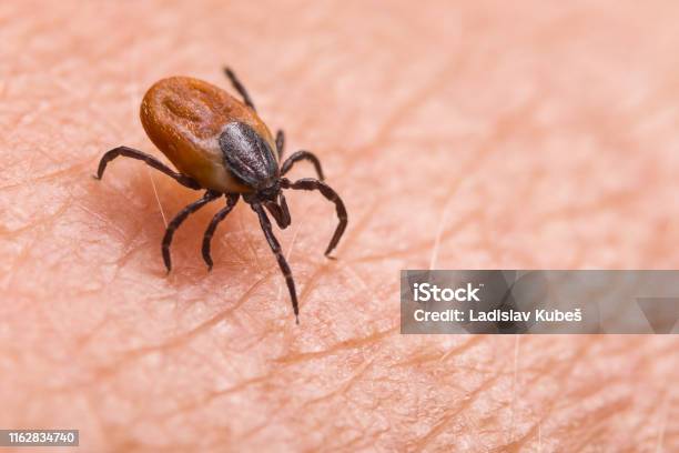 Infected Female Deer Tick On Hairy Human Skin Ixodes Ricinus Dangerous Mite Detail Acarus Infectious Borreliosis Stock Photo - Download Image Now