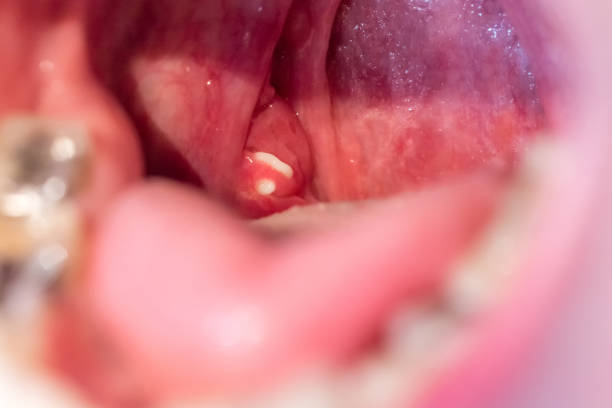 vit man del stenar på palatinen tonsiller som en trigger av dålig andedräkt - tonsill bildbanksfoton och bilder