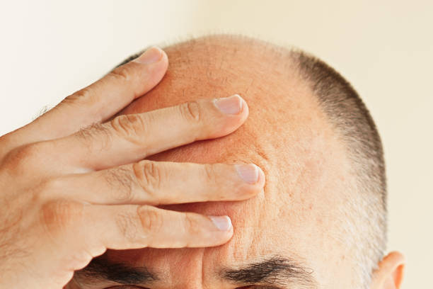 Hair loss - fotografia de stock