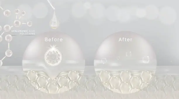 Vector illustration of Hyaluronic acid before and after skin solutions ad, white collagen serum drop with cosmetic advertising background ready to use.