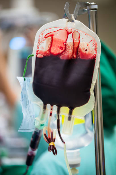 blood in a bag had be gave to help patient that was operating by surgeon and his medical team. - blood bank imagens e fotografias de stock