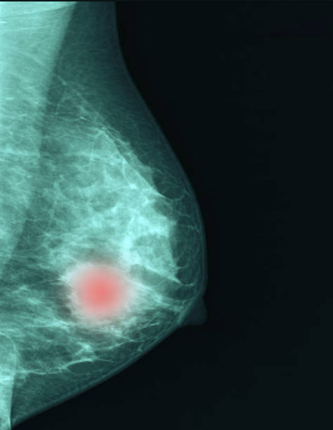 brustkrebs brustkrebs - mammogram mri scan breast breast examination stock-fotos und bilder