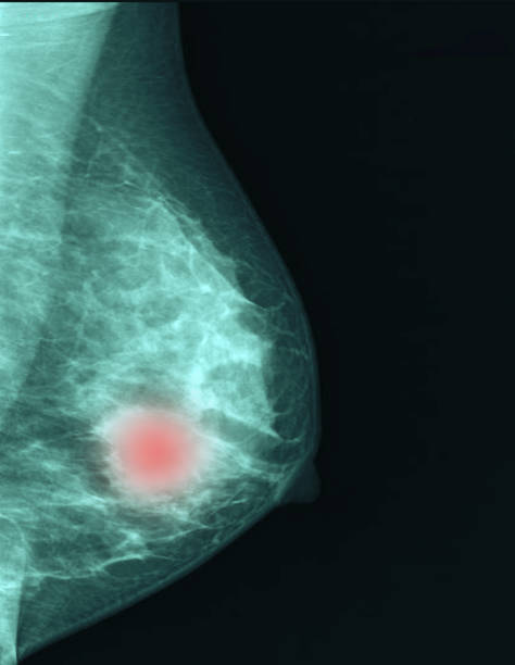 Breast cancer  breaststroke breast cancer or breaststroke images from checkup mammogram of women patient. research foundation stock pictures, royalty-free photos & images