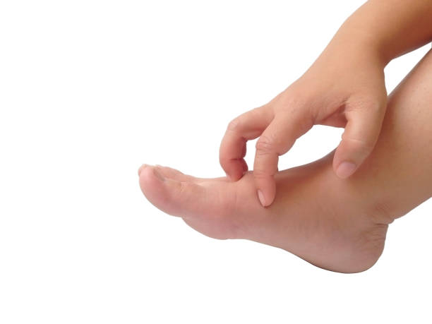 istock Hand scratching foot on white background. Athlete’s foot frequently everyone. 1163260434