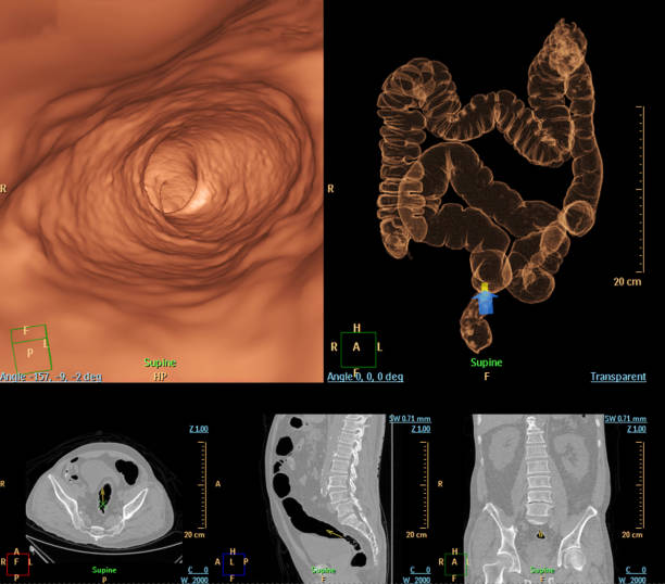 ct 콜로니학은 대장암 스크리닝을 위한 2d 축, 시상, 관상면 및 3d 렌더링 이미지를 비교합니다. 선별 대장암을 확인하십시오. - descending colon 뉴스 사진 이미지