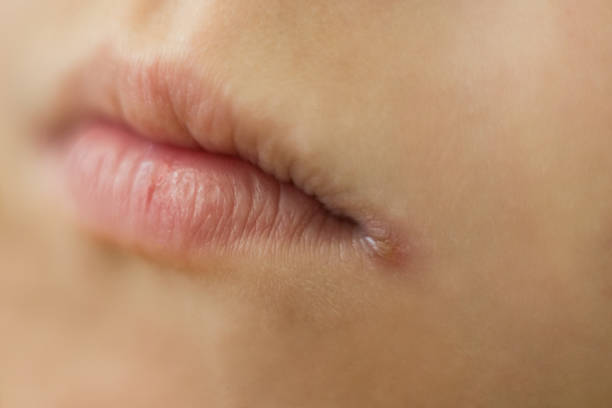 istock skin problems, angulitis, angular stomatitis, angular cheilitis  a disease of the mucous membrane and skin of the corners of the mouth, caused by streptococci 1163366108