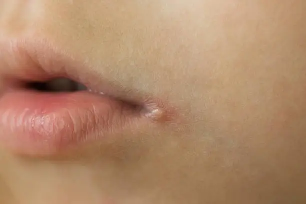 skin problems, angulitis, angular stomatitis, angular cheilitis  a disease of the mucous membrane and skin of the corners of the mouth, caused by streptococci.