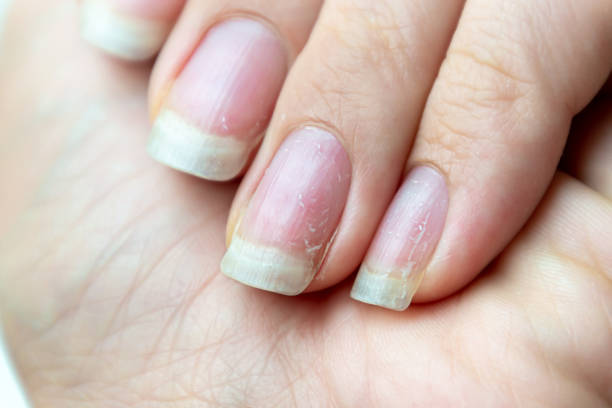 istock Close up of damaged nails that have problem after doing manicure. Health and beauty problem. 1163435670