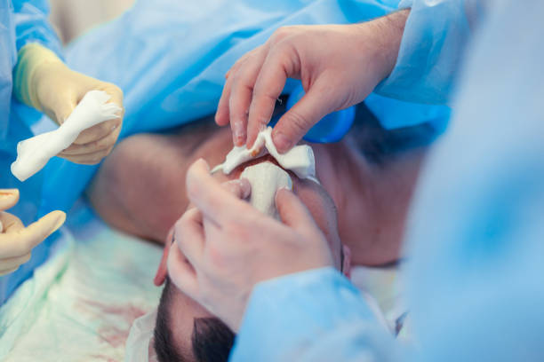 chirurgo e il suo assistente che eseguono chirurgia estetica sul naso in sala operatoria dell'ospedale. rimodellamento del naso, aumento. rinoplastica. installazione di intonaco sul naso - nose job foto e immagini stock