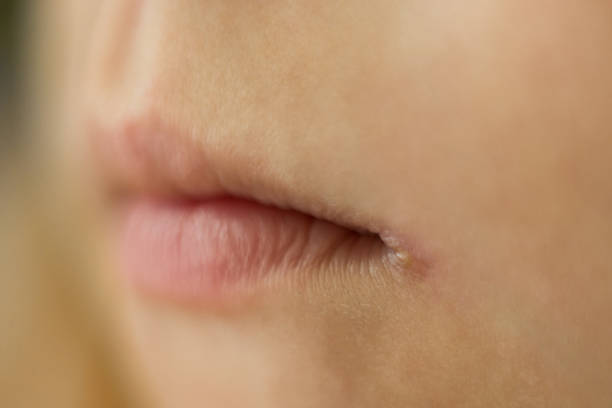 istock skin problems, angulitis, angular stomatitis, angular cheilitis  a disease of the mucous membrane and skin of the corners of the mouth, caused by streptococci 1163581324