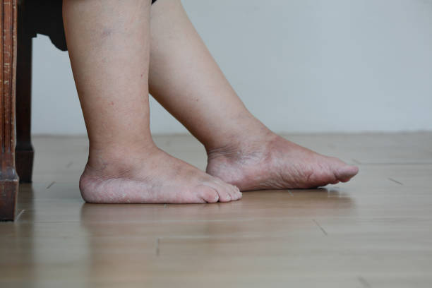 Senior woman swollen feet and leg Senior woman swollen feet and leg swollen stock pictures, royalty-free photos & images