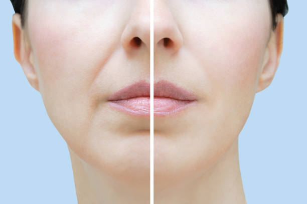 Nasolabial folds in a Caucasian woman. Face close up. Before and after. Nasolabial folds in a Caucasian woman. Face close up. Before and after. botox before and after stock pictures, royalty-free photos & images