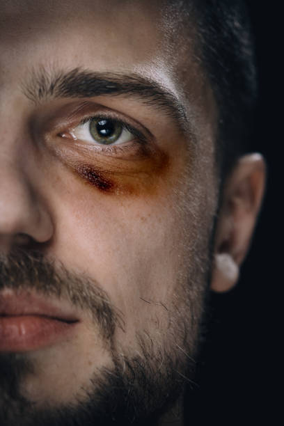 istock Beaten aggression victim with black eye. 1163758250