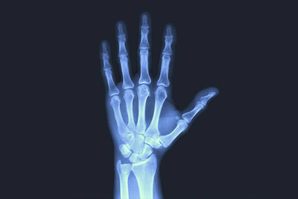 X-rayed human hand. X-ray of hand bones. stock photo