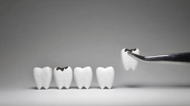istock Decayed tooth model was pinch if don't brush the teeth every day, tooth will not unhealthy 1164058807