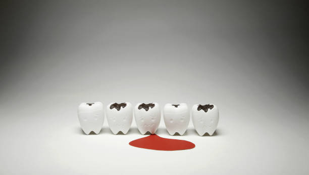 istock Model of Decayed tooth and Scurvy Teeth Bleeding for Dental Unhealthy 1164070272