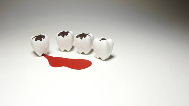 istock Scurvy Teeth Bleeding and Decayed teeth Model warning Dental Unhealthy 1164070419
