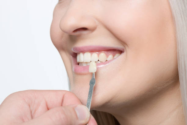 istock Using shade guide at woman's mouth to check veneer of tooth crown 1164174572