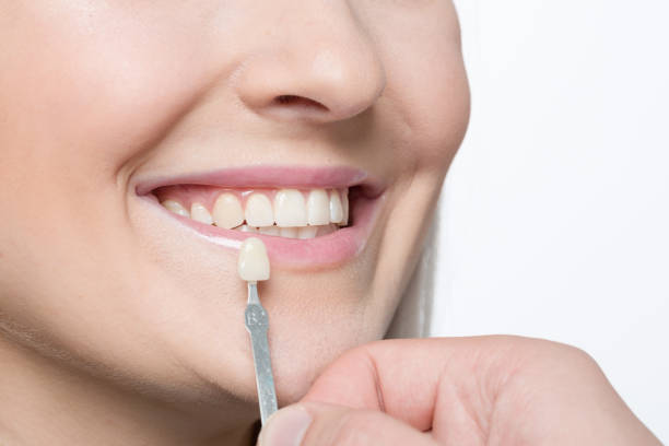 istock Using shade guide at woman's mouth to check veneer of tooth crown 1164174602
