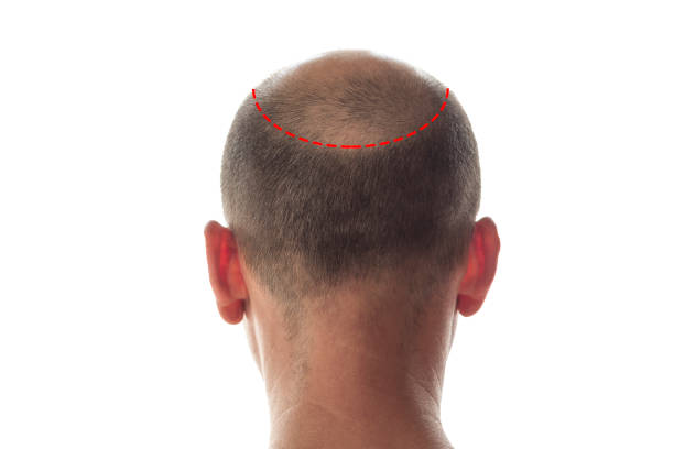 Bald man head on the back Bald man back view, head with hair loss skin head stock pictures, royalty-free photos & images