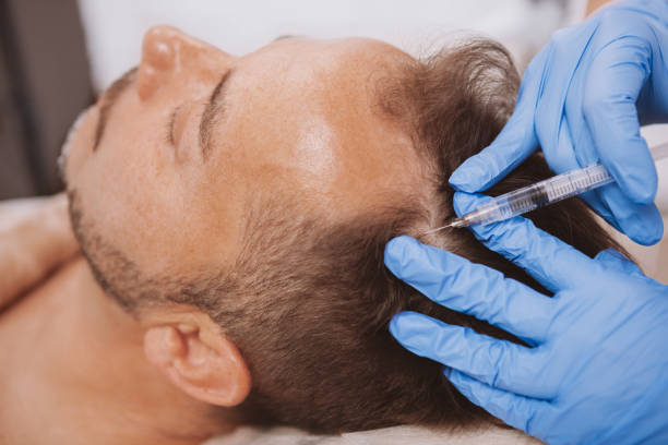 Mature man getting facial skincare treatment at spa beauty salon Close up of a mature man receiving hairloss treatment injections in scalp by professional trichologist. Dermatologist doing scalp injections for mature male client with alopecia problem beauty treatment stock pictures, royalty-free photos & images