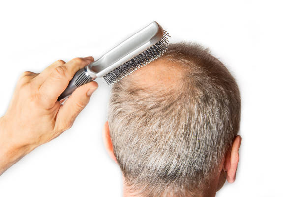 bald man with comb. hair loss concept - completely bald fotos imagens e fotografias de stock