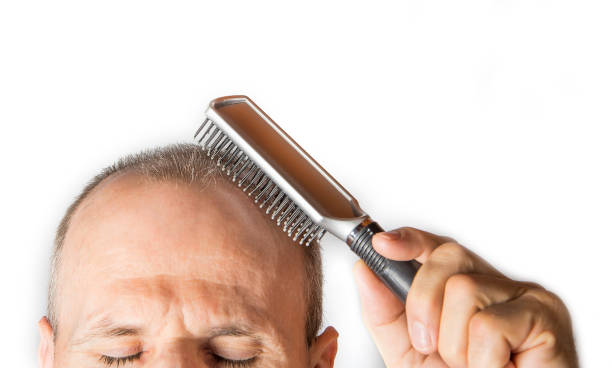 bald man with comb. hair loss concept - completely bald imagens e fotografias de stock