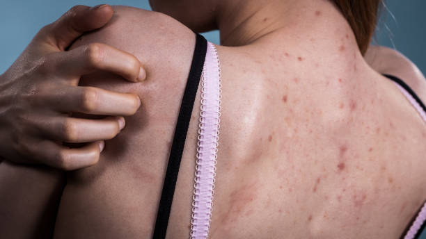 istock Woman with skin problem acne on back 1164288776