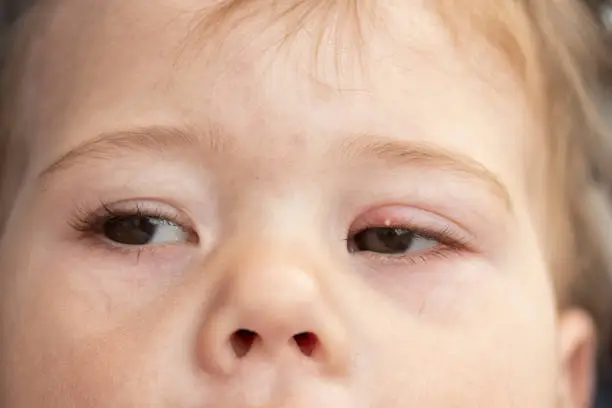 Photo of White pimple on the upper eyelid of the eye, milium. Inflammation of the eye of a small baby child, conjunctivitis. Milium is a small, hard, pale keratinous nodule formed on the skin soft focus